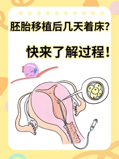 胚胎移植手术过程