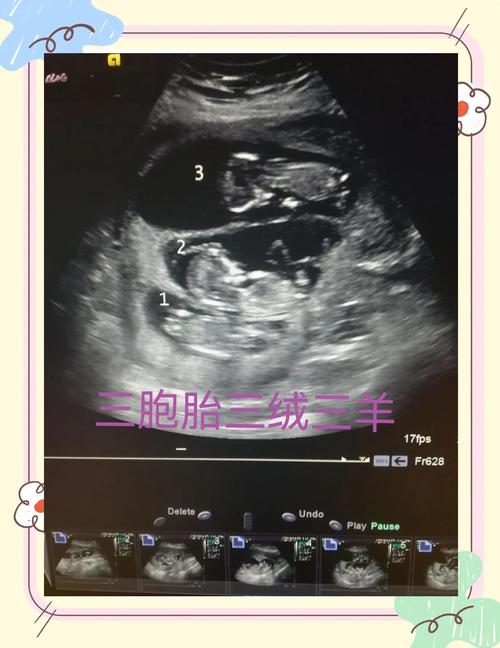 多胎妊娠超声检查